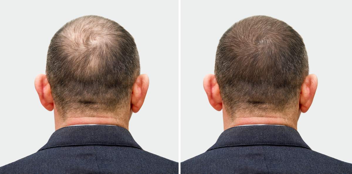 Albania or Turkey Hair Transplant Comparison.jpg