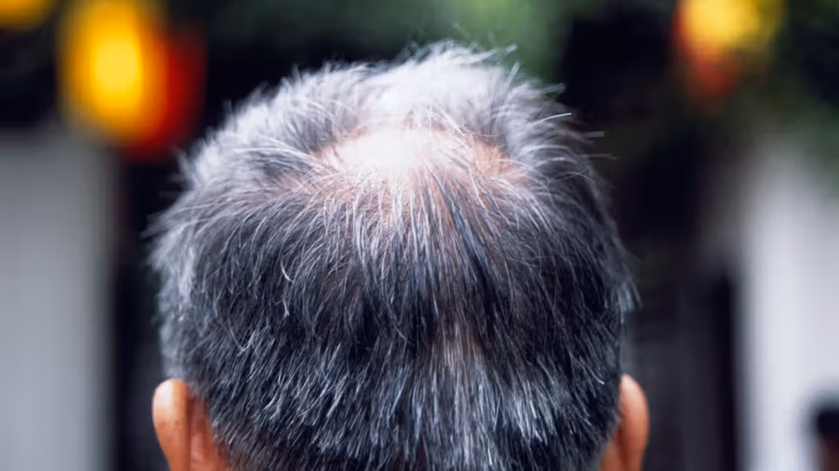 Caduta Capelli Cause.avif