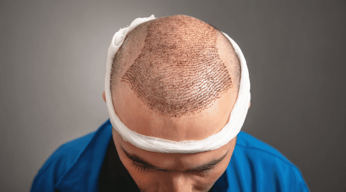 What to Do After a Hair Transplant? 2026.png