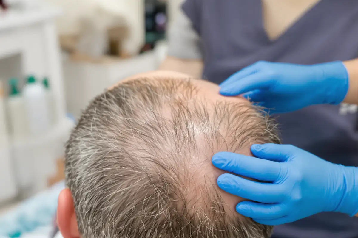 Arrossamento e irritazione dopo il trapianto di capelli: Cause