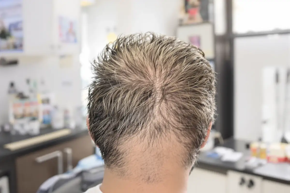 Turkey Hair Transplant: Is It Really Good?