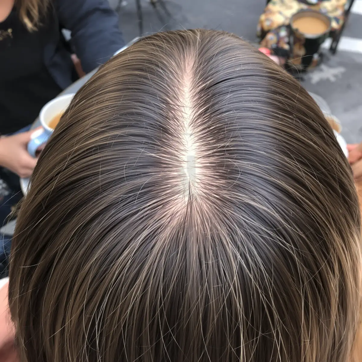 Detaj i vijës së flokëve që zgjerohet për shkak të alopecisë androgenetike.