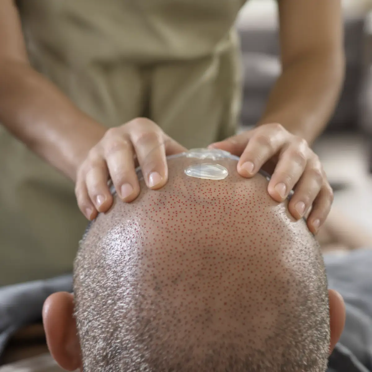 Cure post-operatorie applicate sull'area ricevente