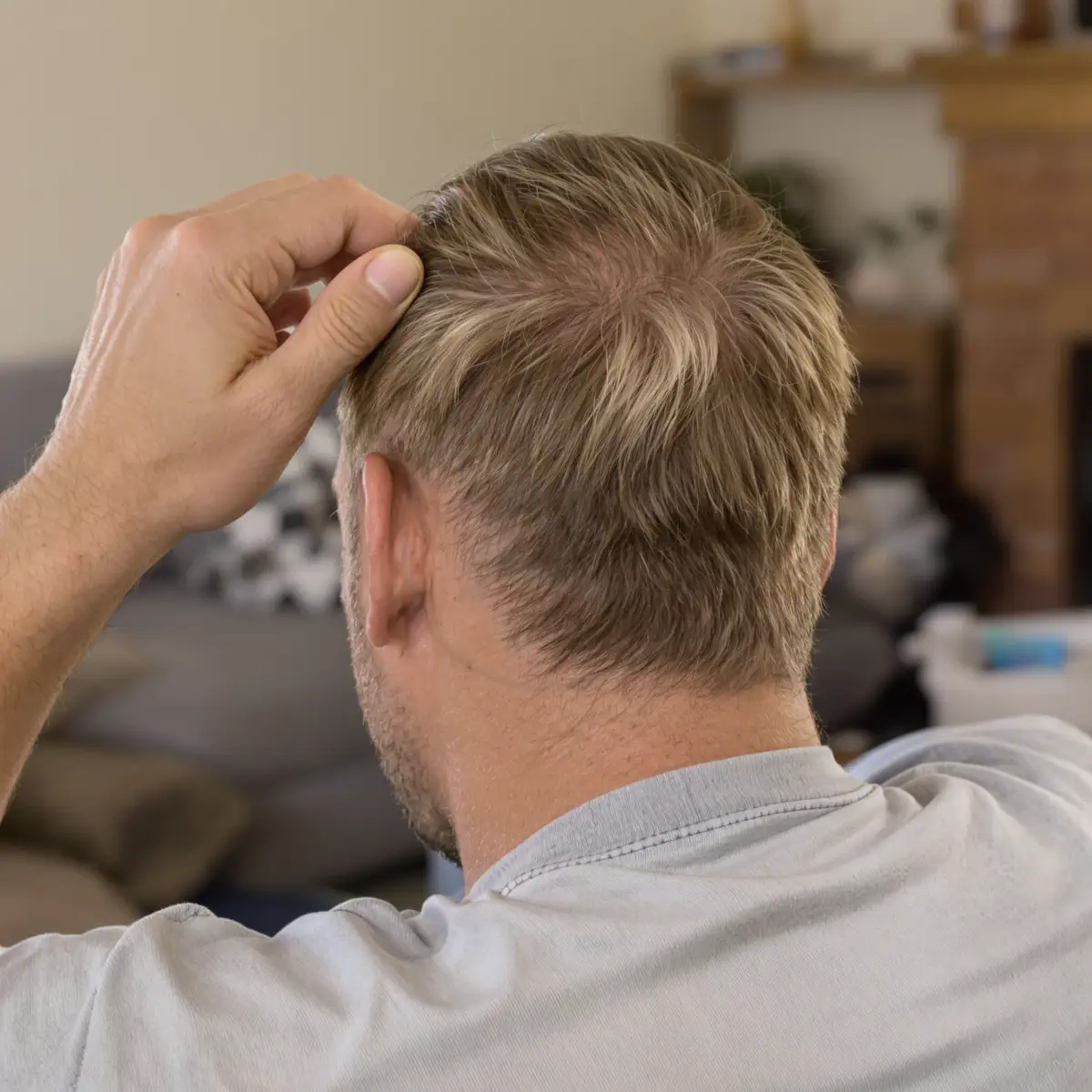 Primo piano di capelli che si diradano sulla nuca di un uomo.