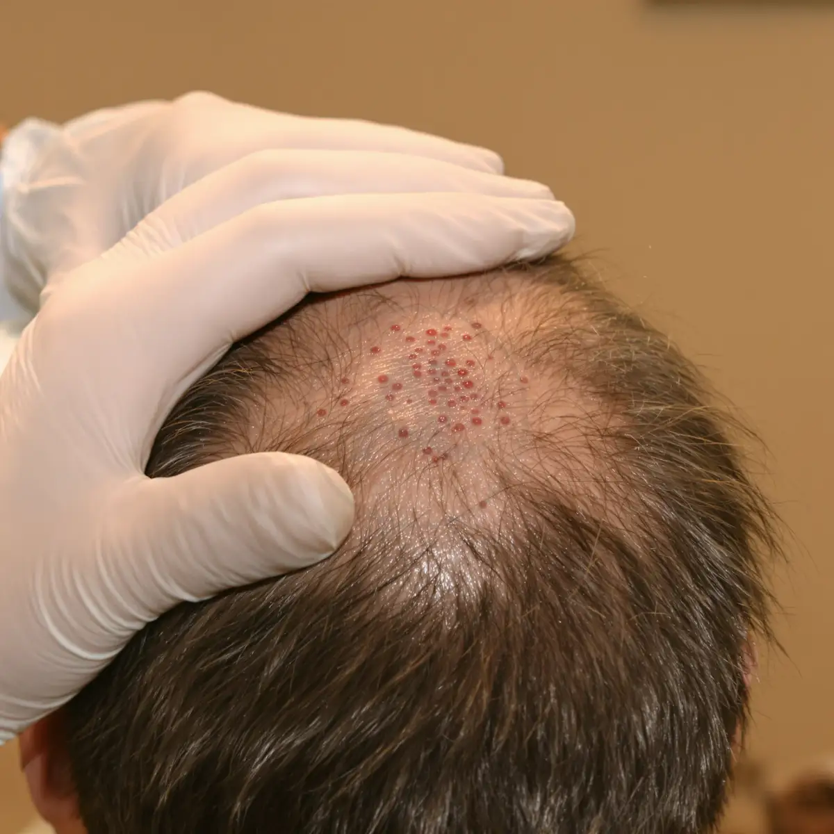 Dettaglio del cuoio capelluto con innesti, capelli lunghi non rasati.