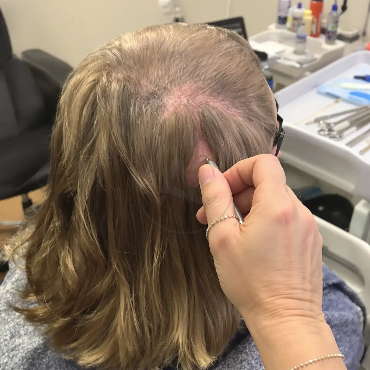 Medico esegue estrazione FUE senza rasatura su uomo con capelli medi.