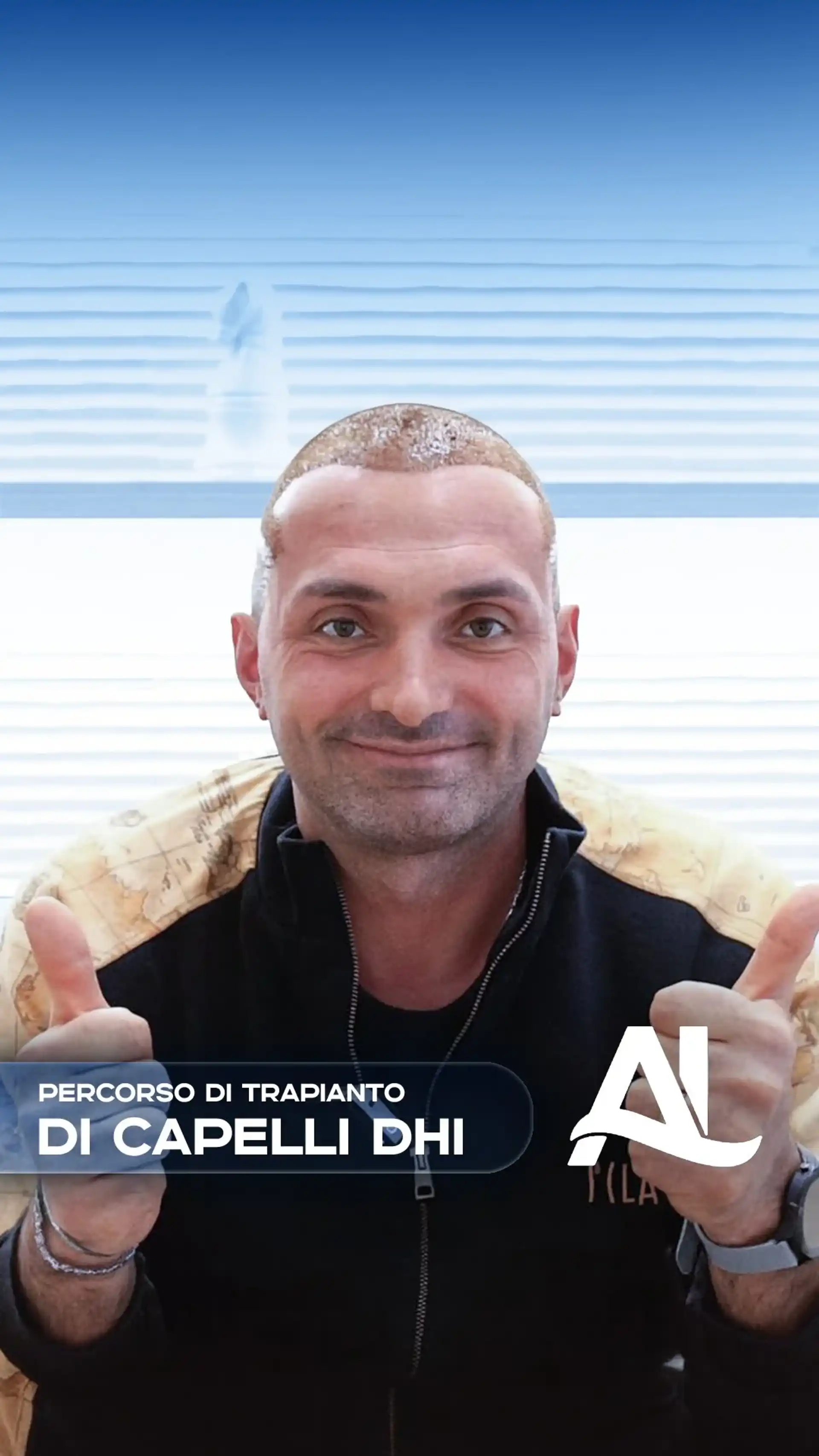 trapianto di capellidhi-insta