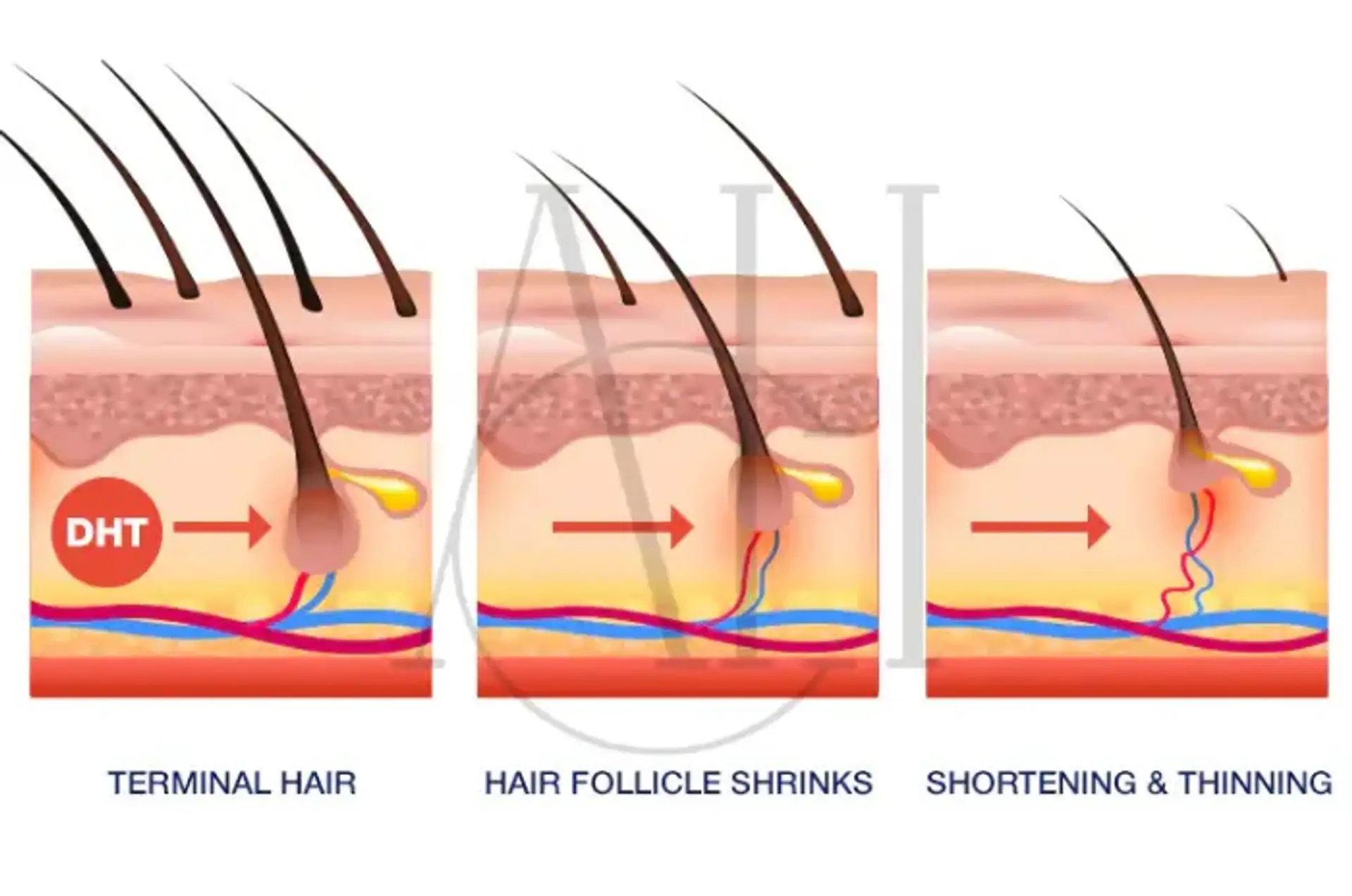 DHT Blockers Explained How They Work and Effectiveness for Hair Loss