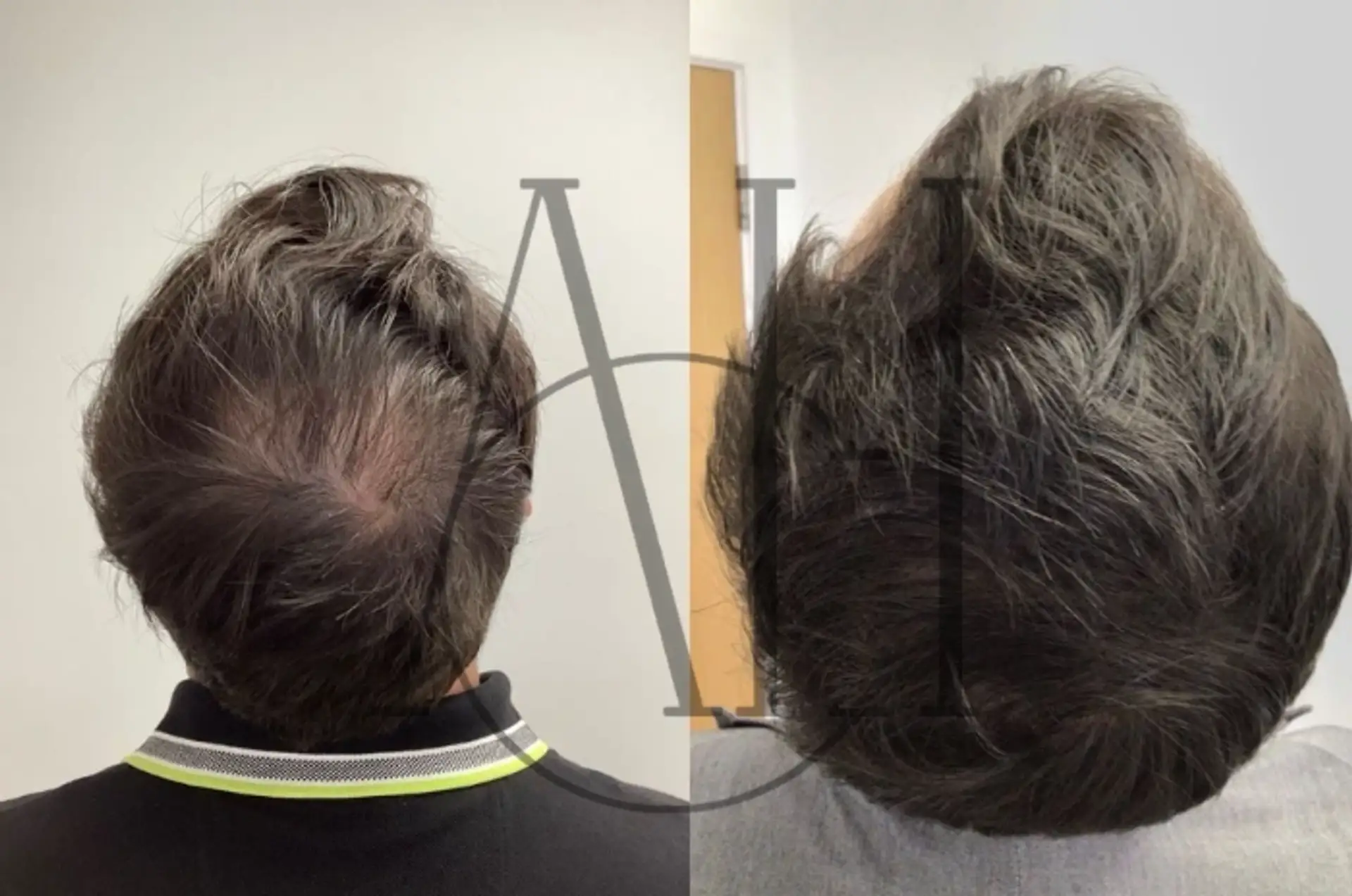 prp treatment