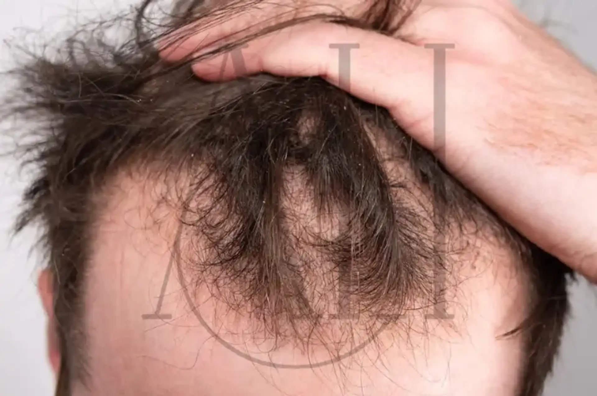 La cura della calvizie Ultimi progressi nella cura della caduta dei capelli