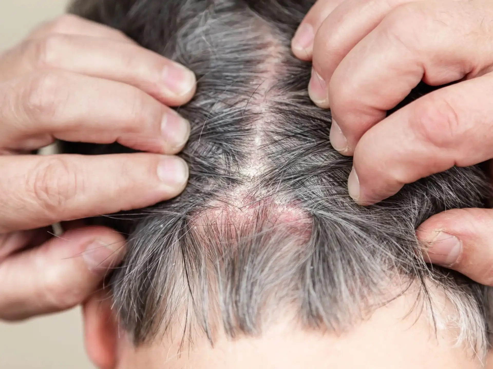 Itchy Scalp and Hair Loss Causes Links and Effective Treatments