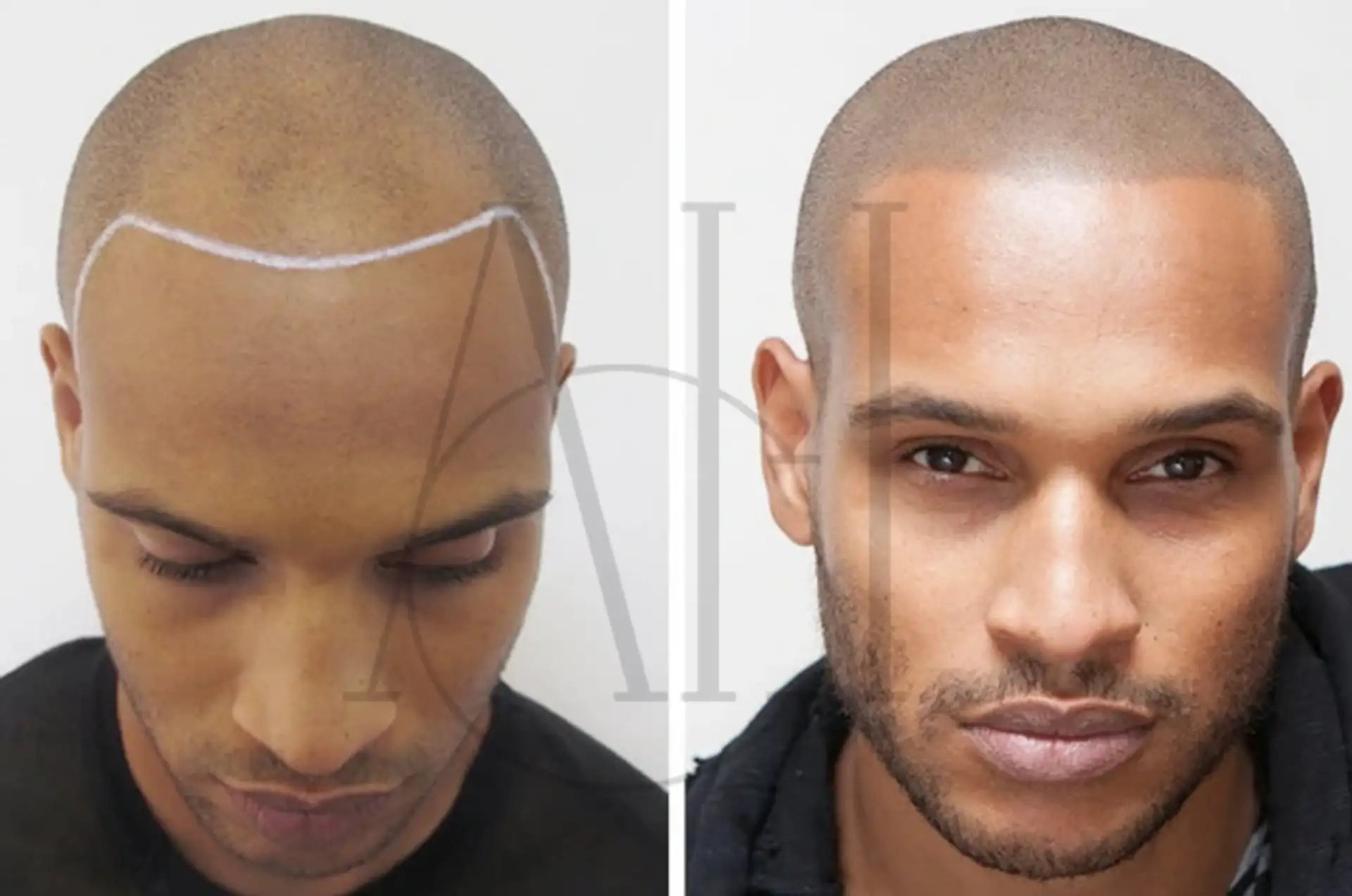 Tatuaggio dei capelli per gli uomini: Pro e contro