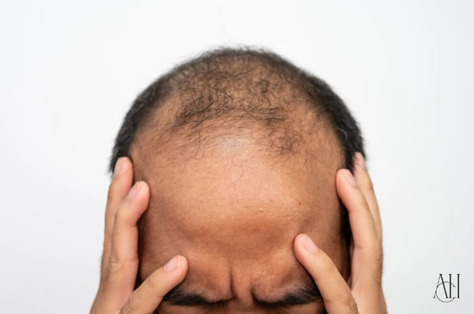 The Complete Guide to Stress-Related Hair Loss: Causes