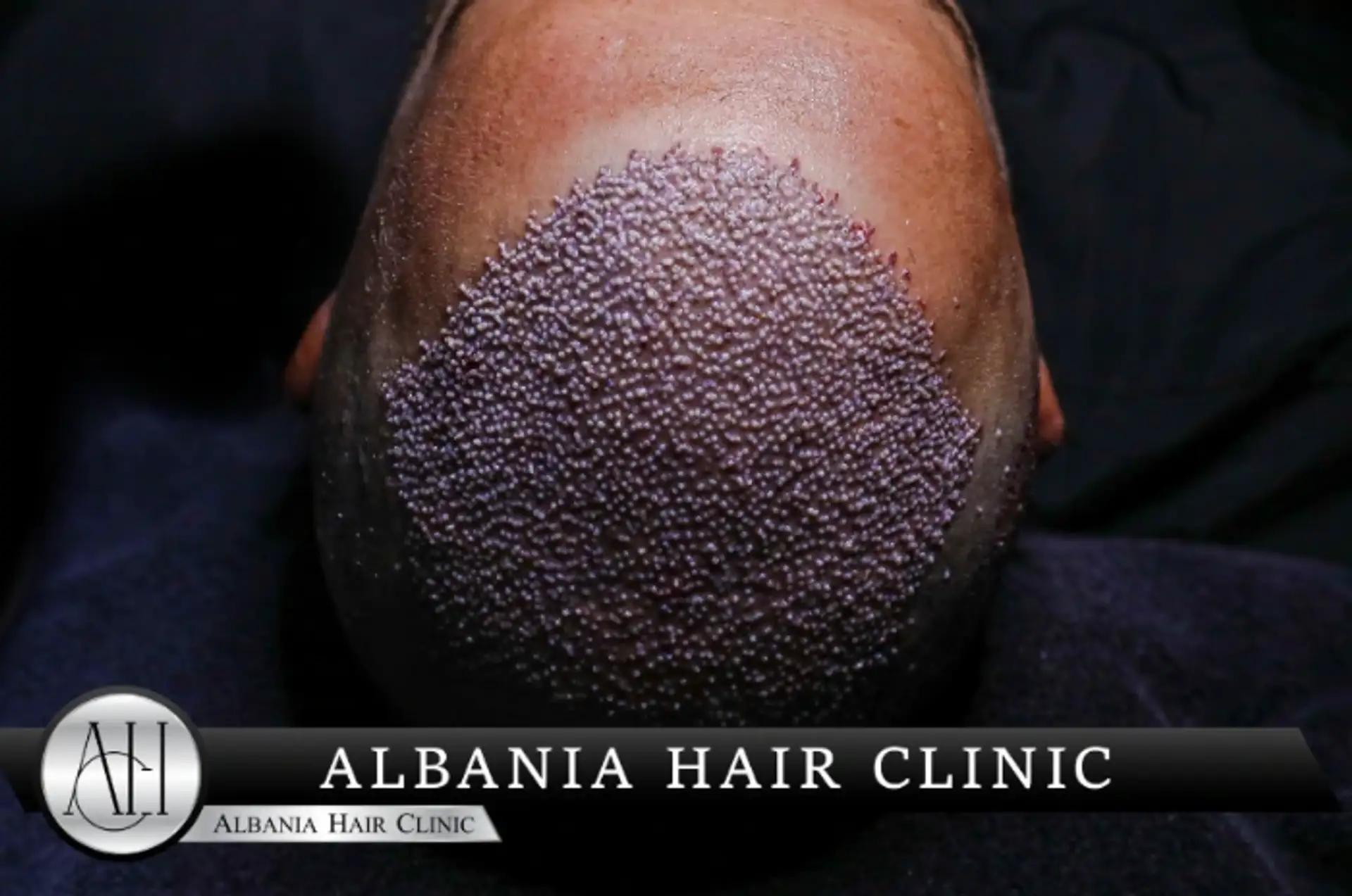 How Long Does a Hair Transplant Last