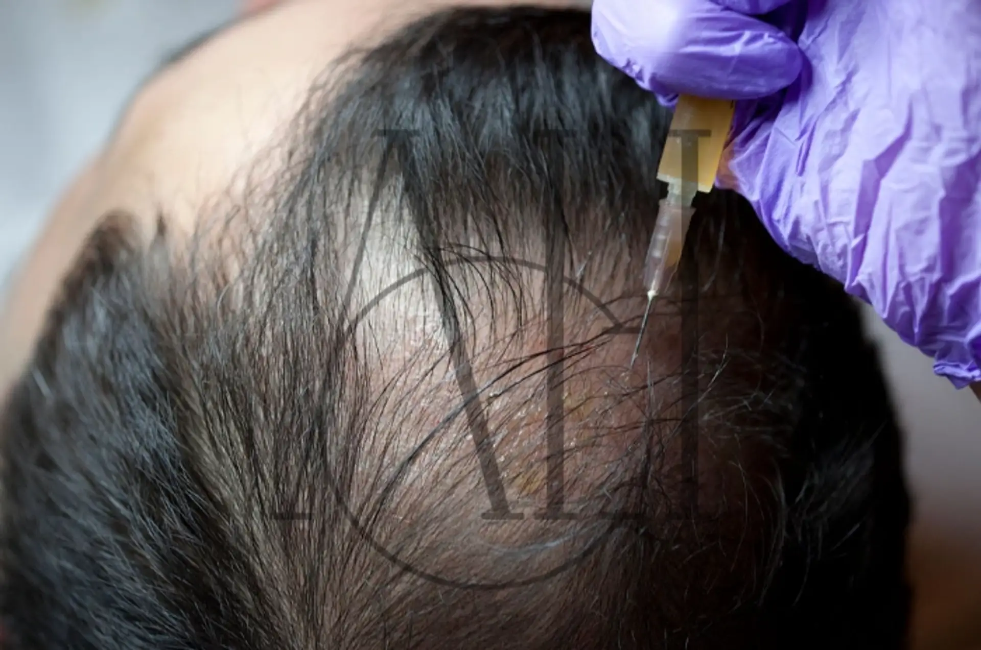 Trattamento PRP per la caduta dei capelli