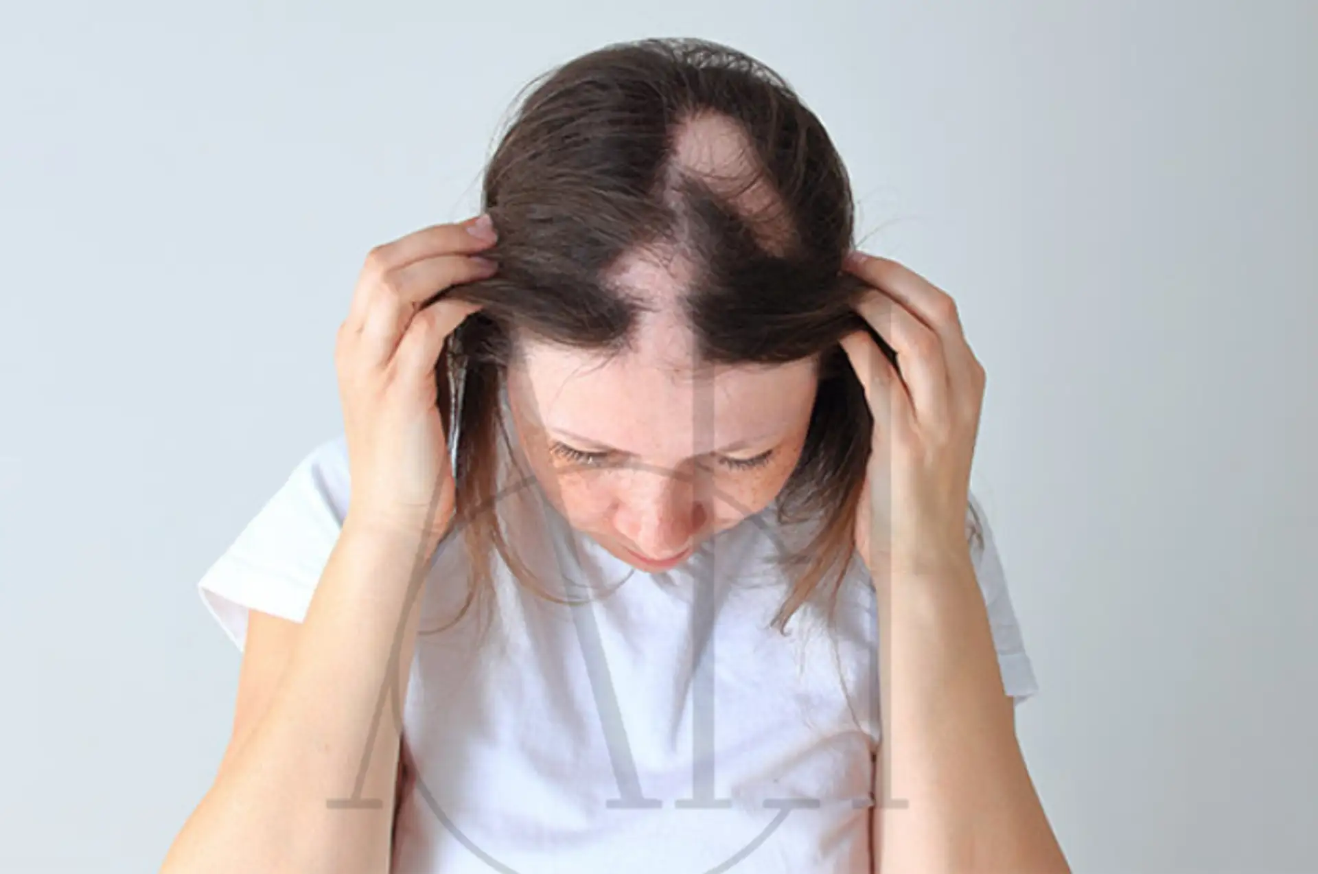 Comprensione dei segni della perdita di capelli LPP