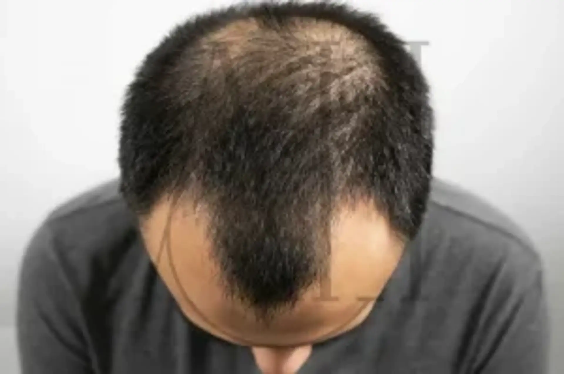 Latest Developments in New Generation Hair Loss Treatment