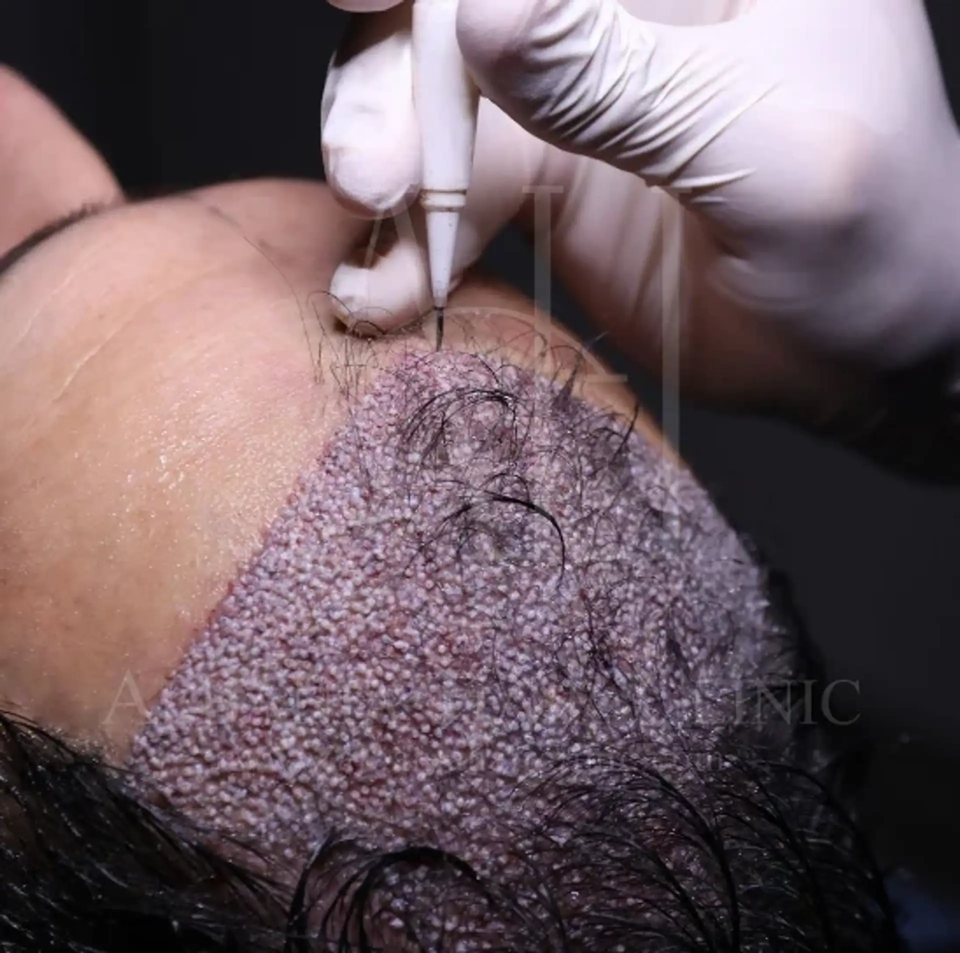 Hair Transplant and Seasonal Effects: How Seasons Influence Your Hair Restoration Journey