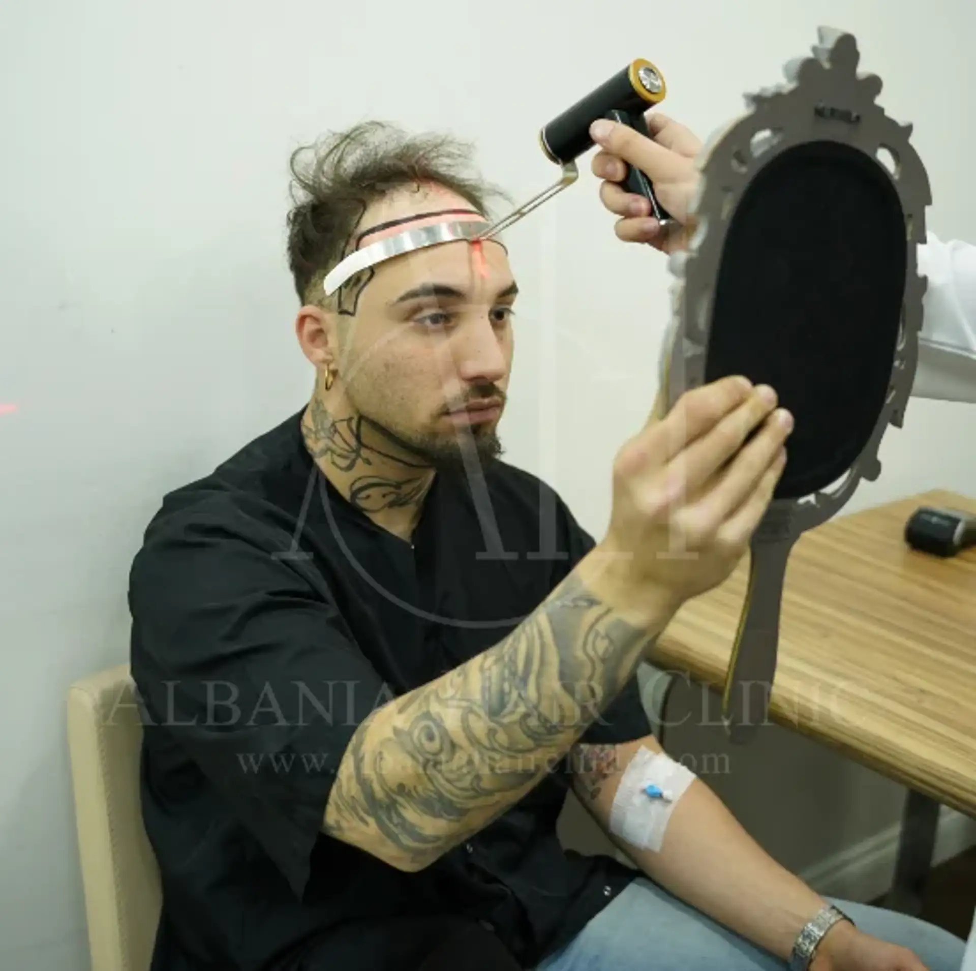 Recupero dell'area donatrice del trapianto di capelli