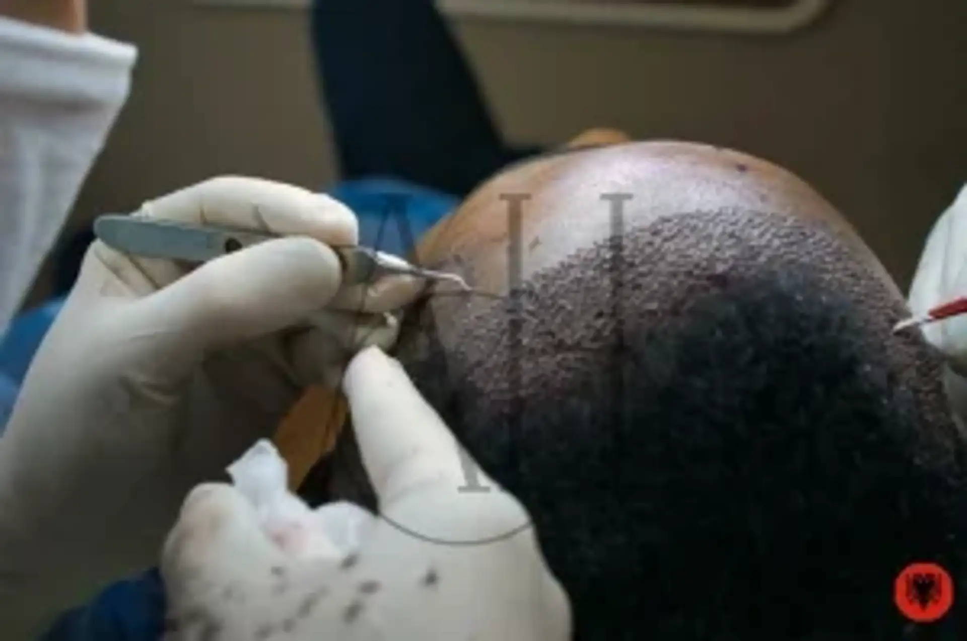 Hair Transplant in Albania: Discover Top Procedures in Tirana