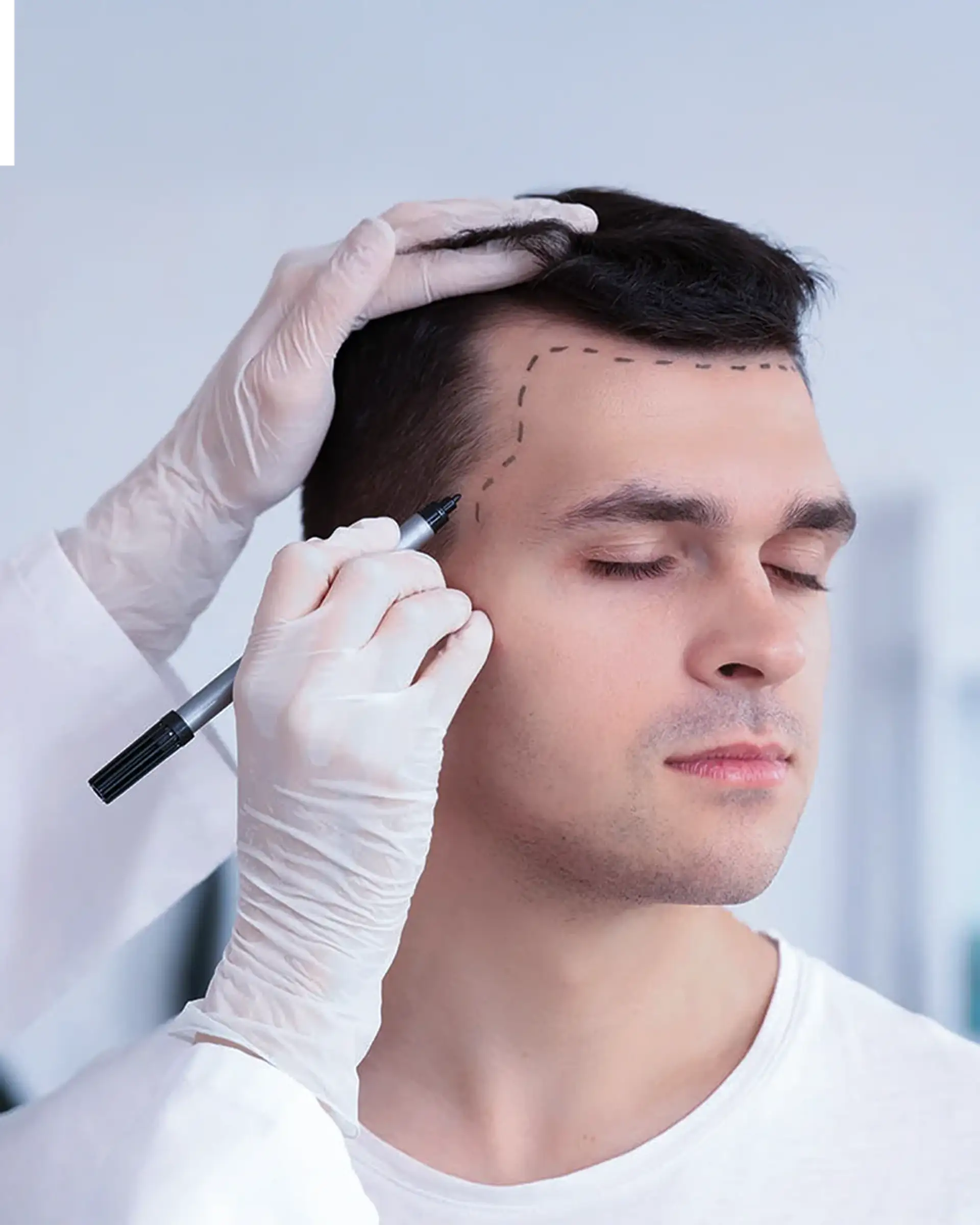 what-is-dhi-trapianto-di-capelli