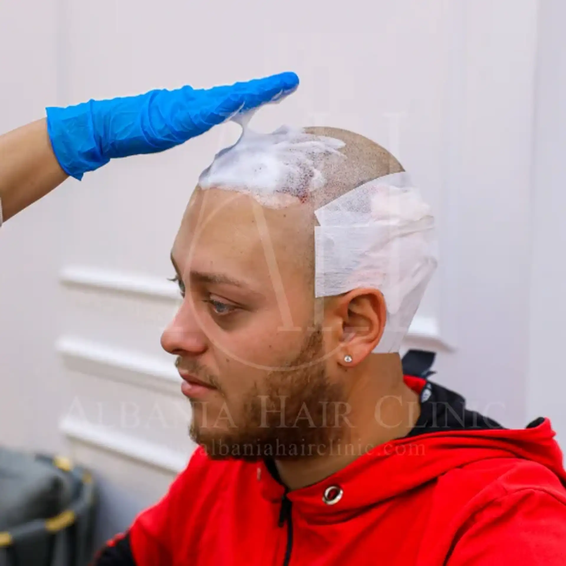Hair density After Transplant - What to expect