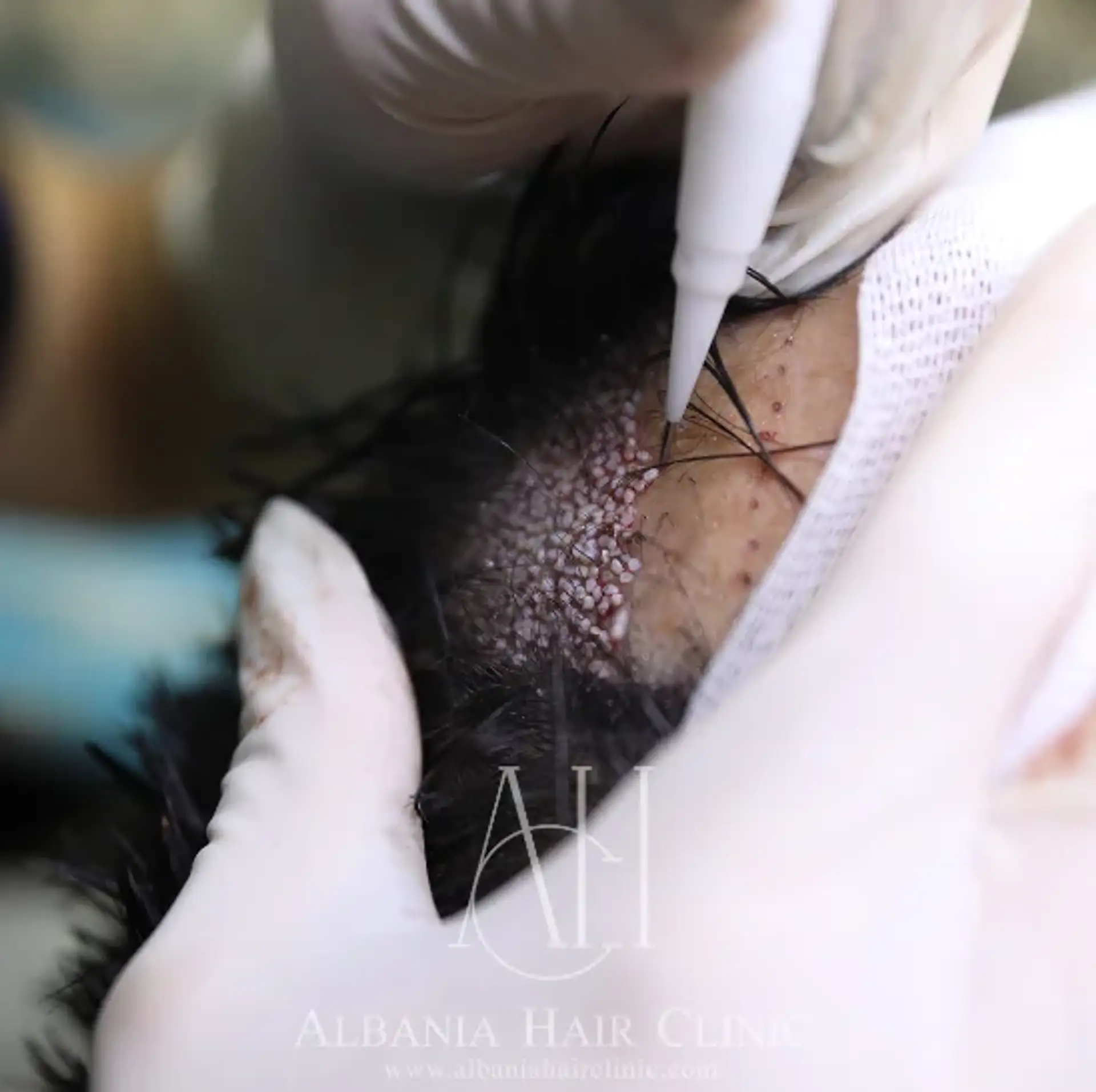 Hair Transplant Technology Advancements