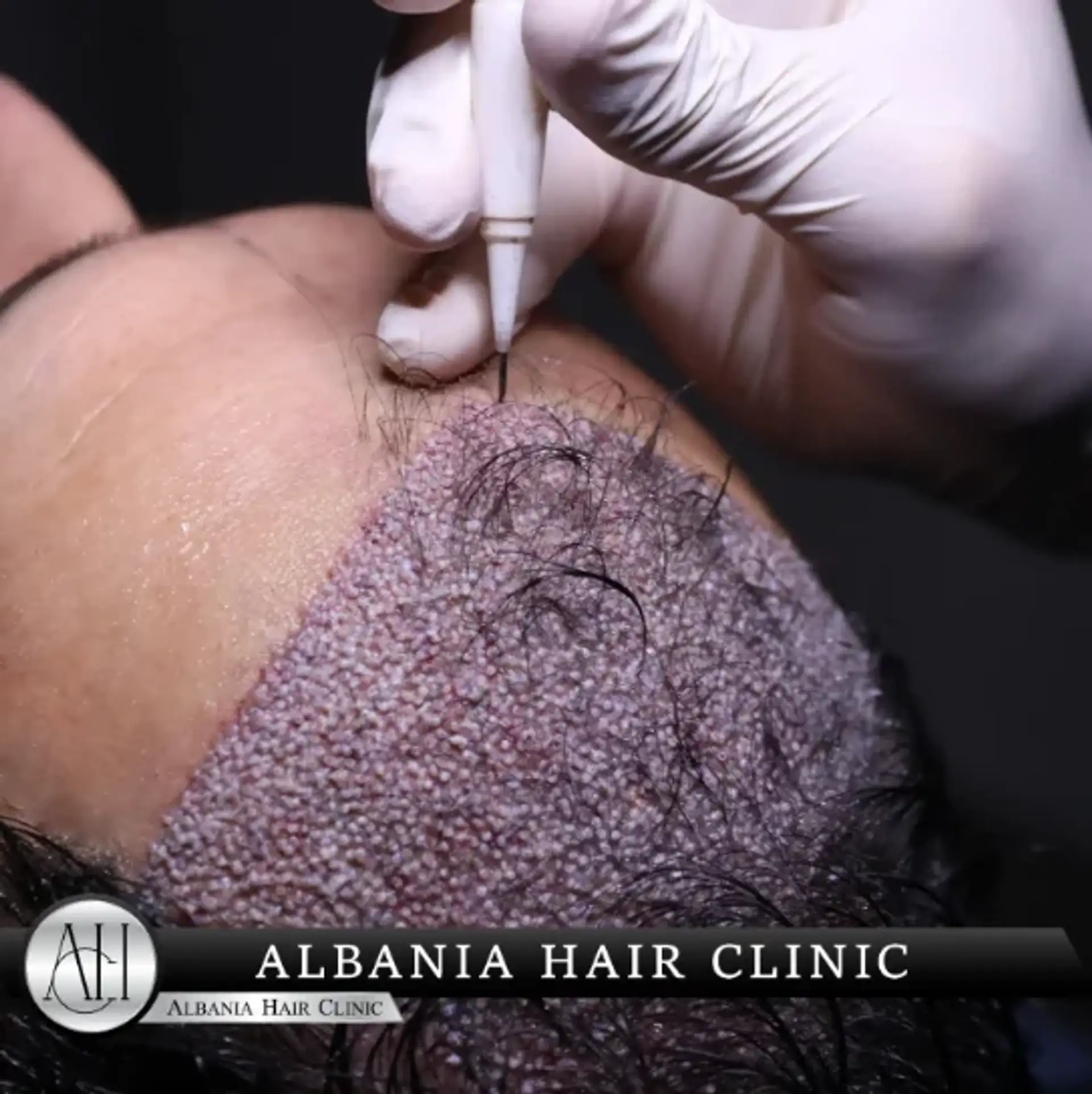 How To Exercise After Hair Transplant