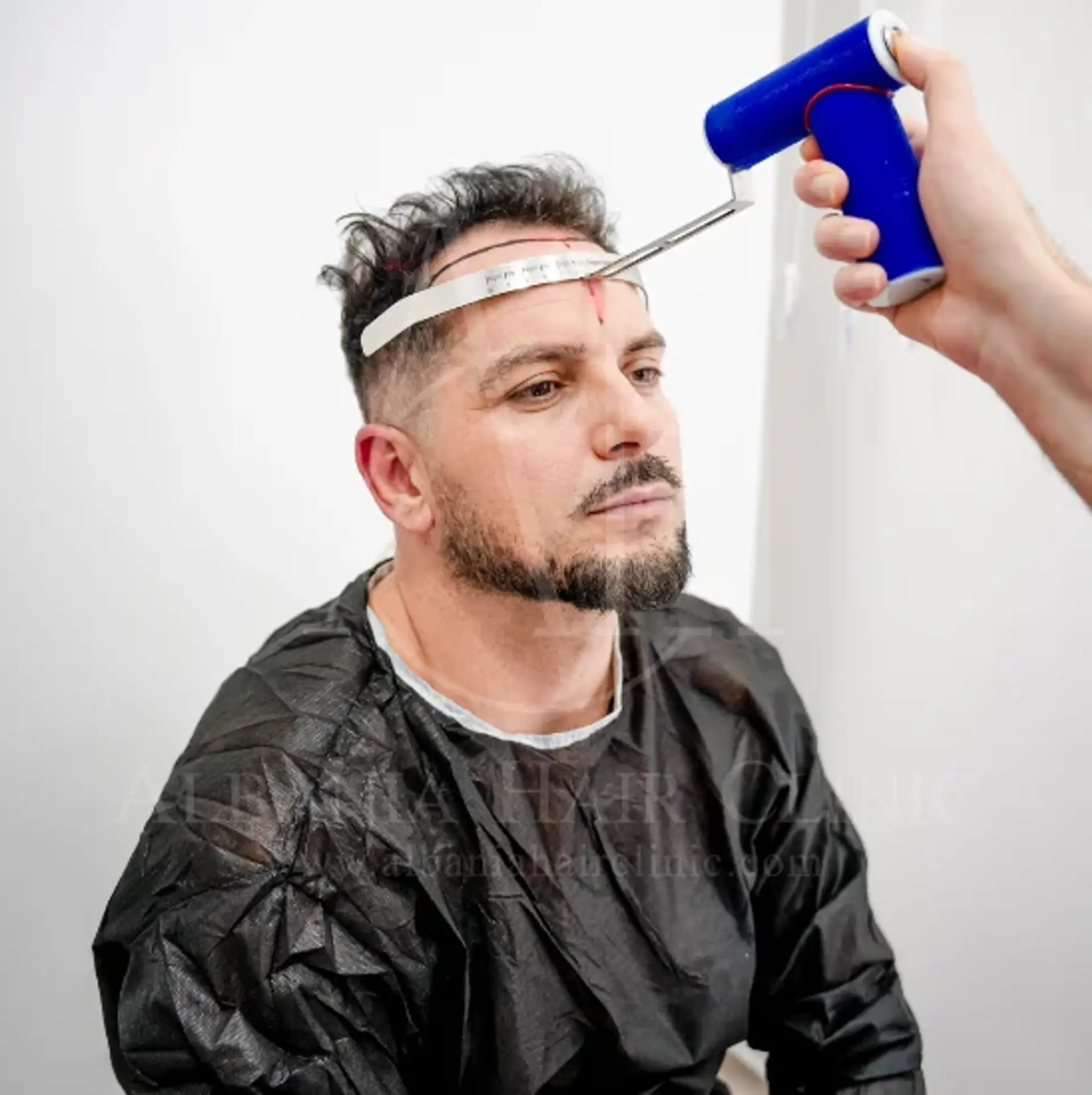 Hair Transplant Sun Exposure Guidelines