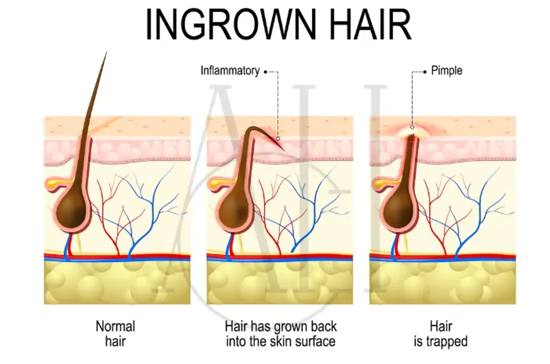 Peli incarniti vs herpes: sintomi