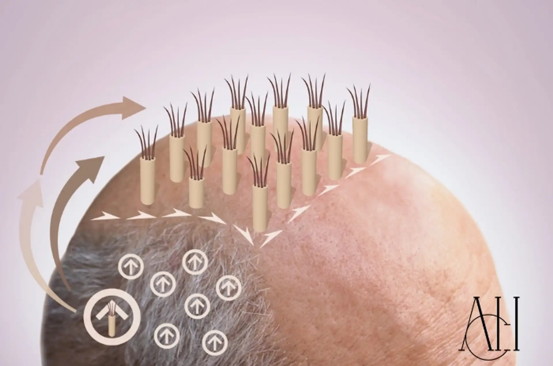 Surgical vs. Non-Surgical Hair Loss Solutions