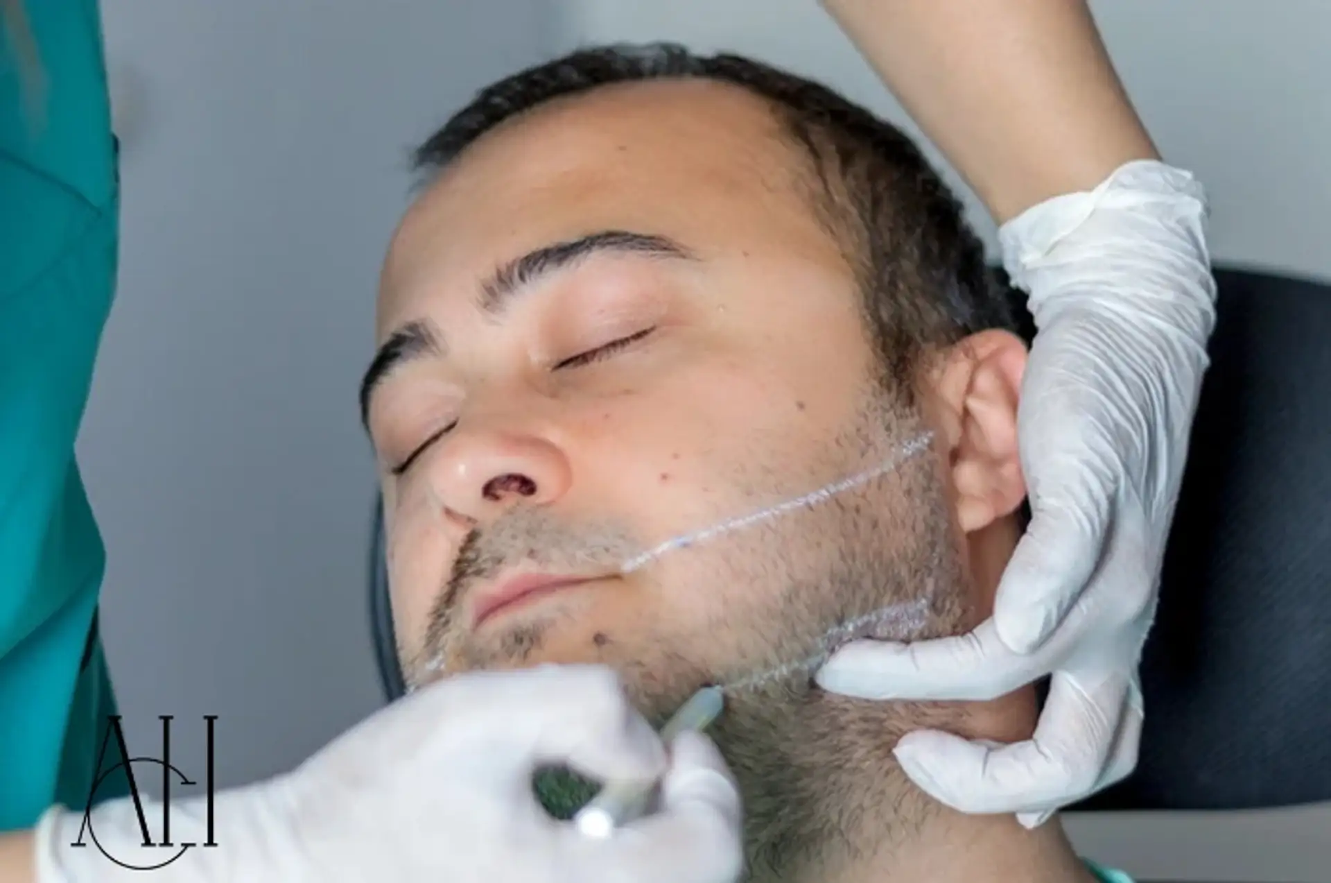 beard-hair-transplant-albania