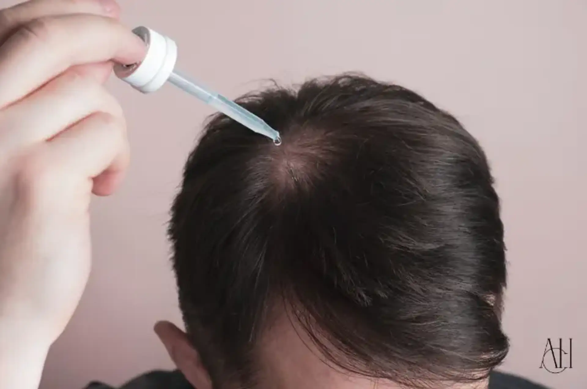 stress hair loss symptoms