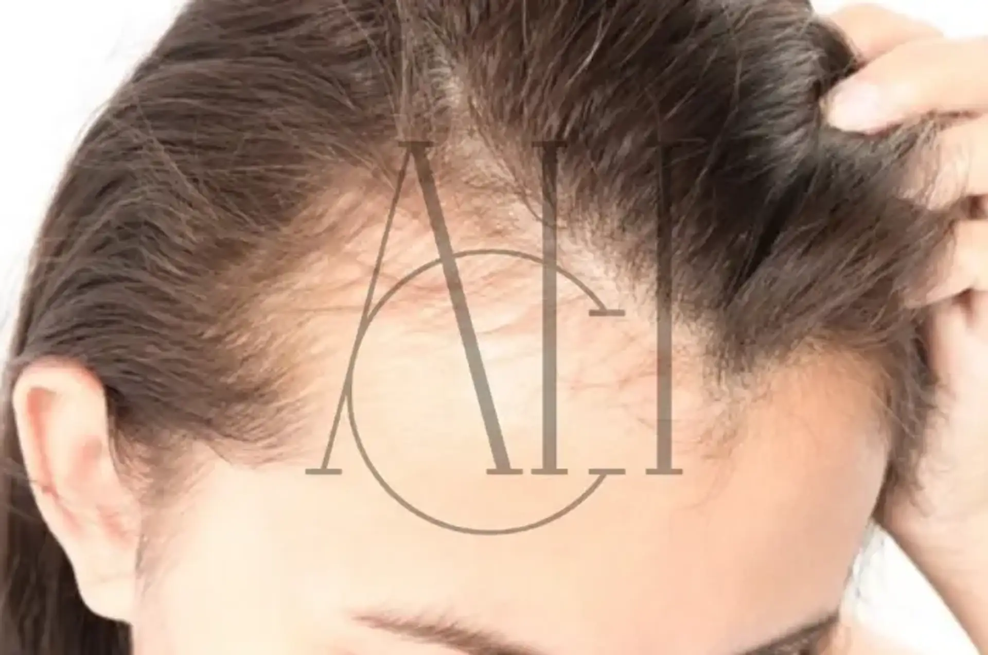 Does hair grow back after traction alopecia?