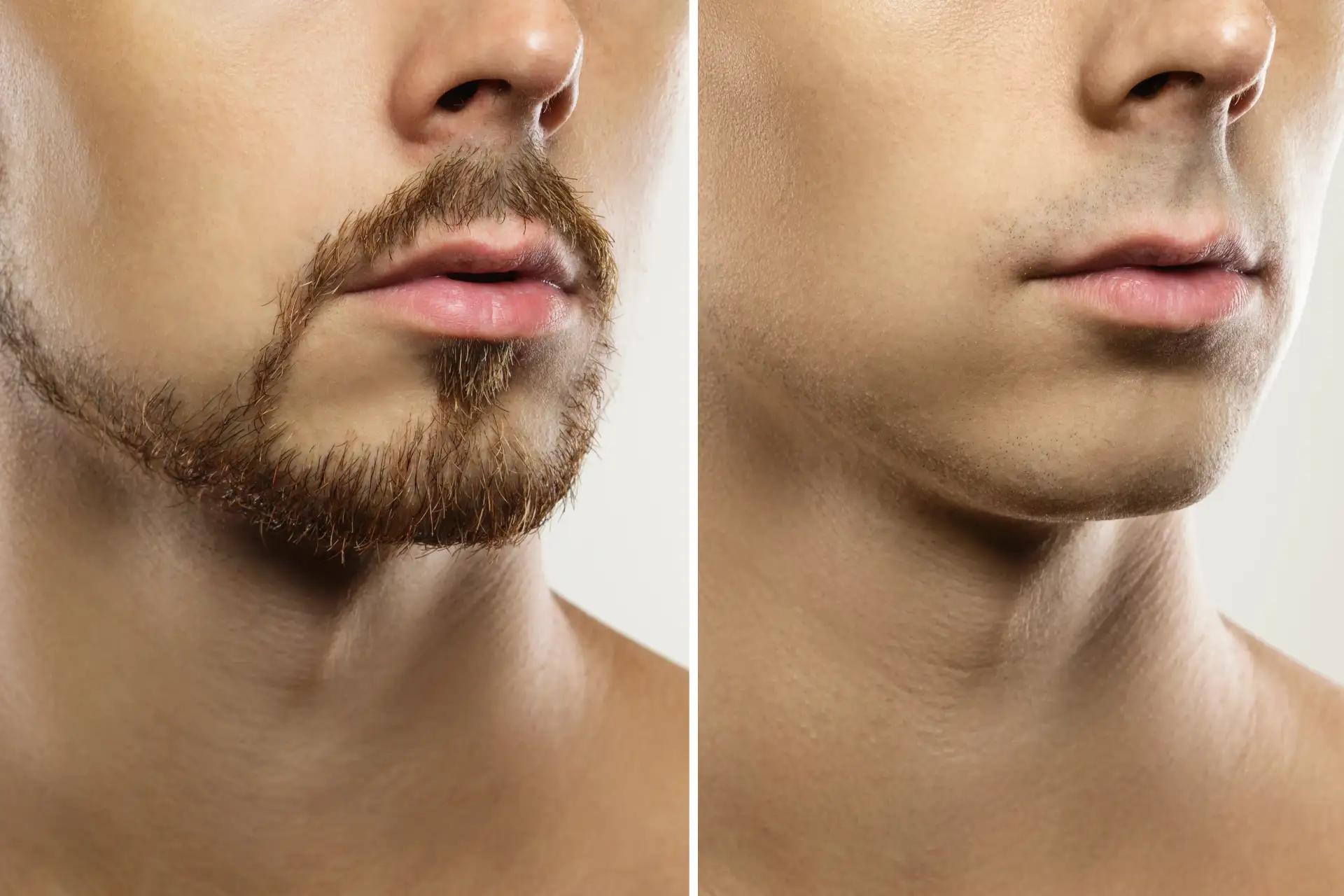 beard-restoration