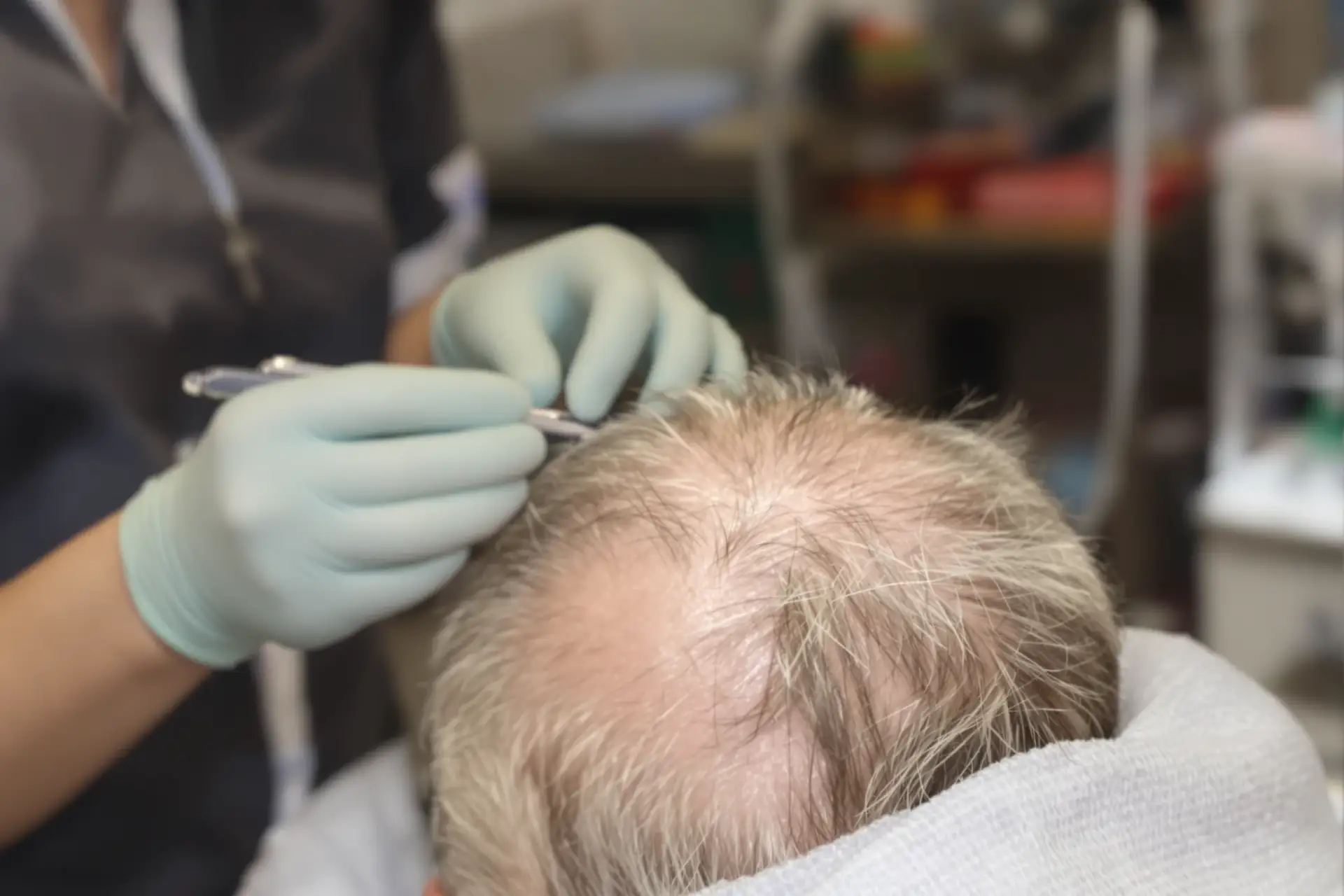 Mani con guanti chirurgici che esaminano con uno strumento sottile il cuoio capelluto diradato di un uomo seduto sulla poltrona di uno studio medico