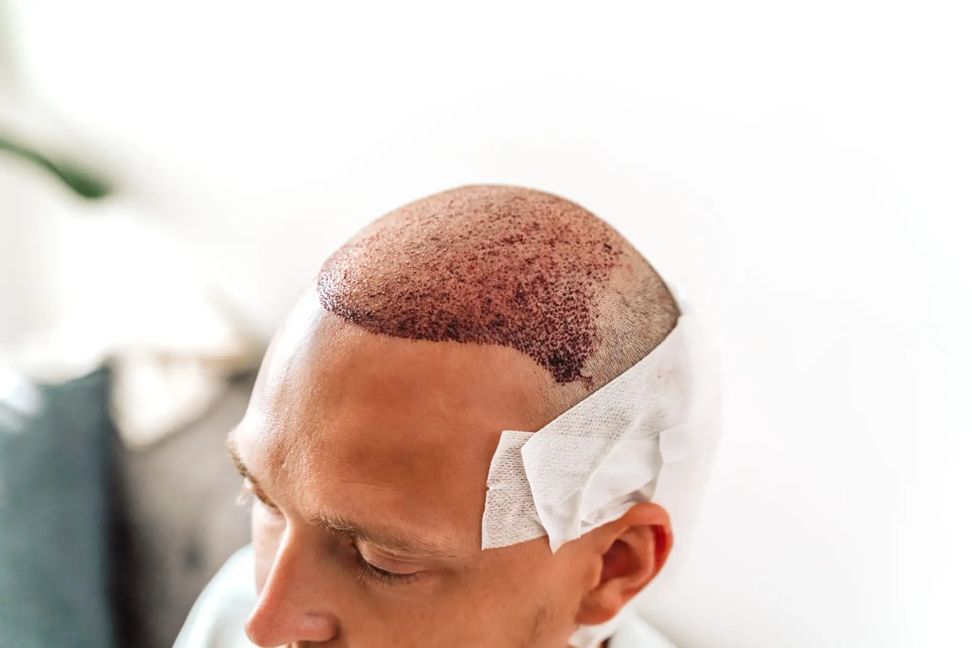 Primo piano della testa di un uomo nelle ore successive a un trapianto di capelli: area ricevente arrossata con innesti appena impiantati e benda di garza sul lato