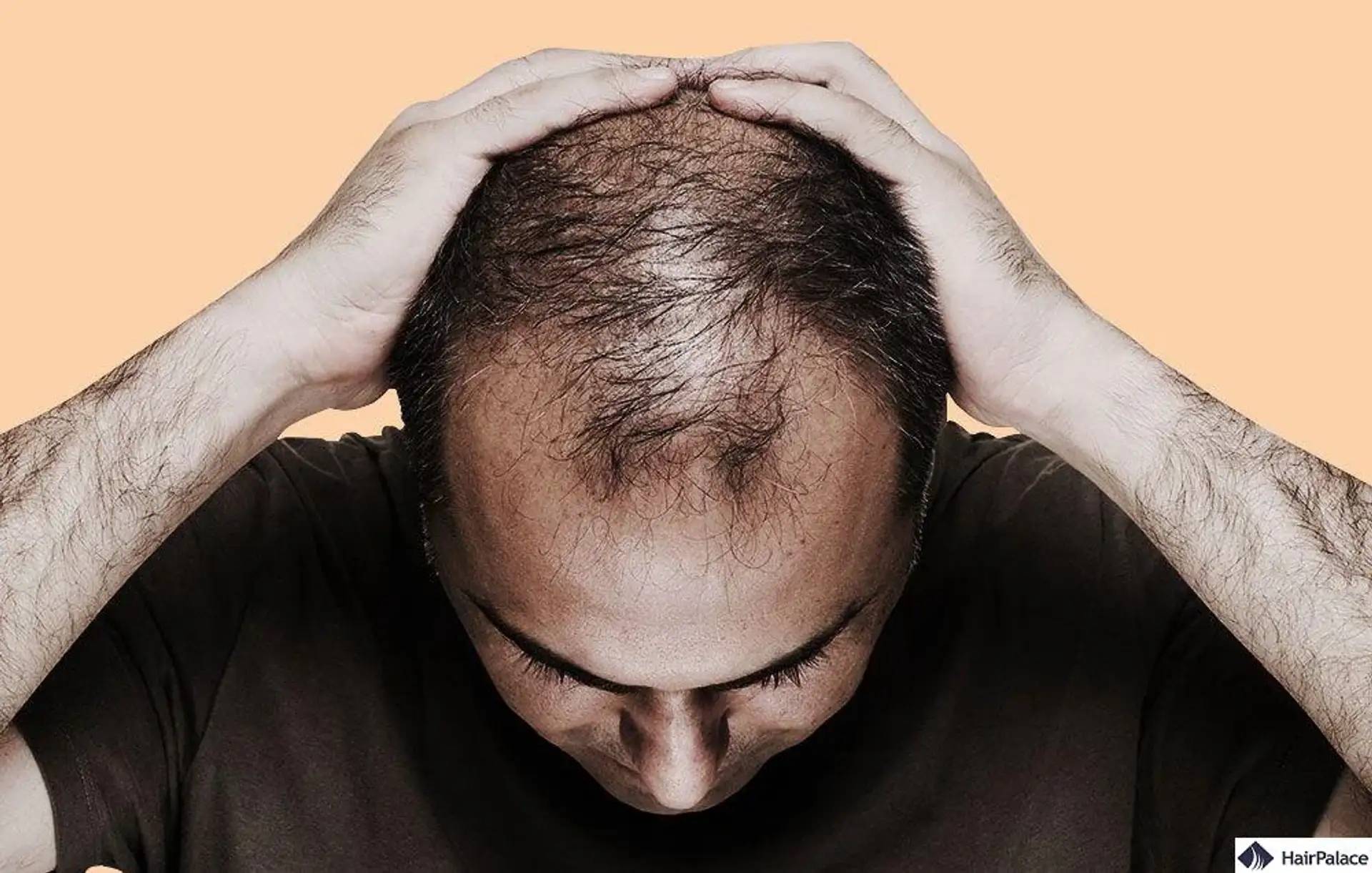 Trapianto Capelli Roma — Clinica e Alternativa in Albania