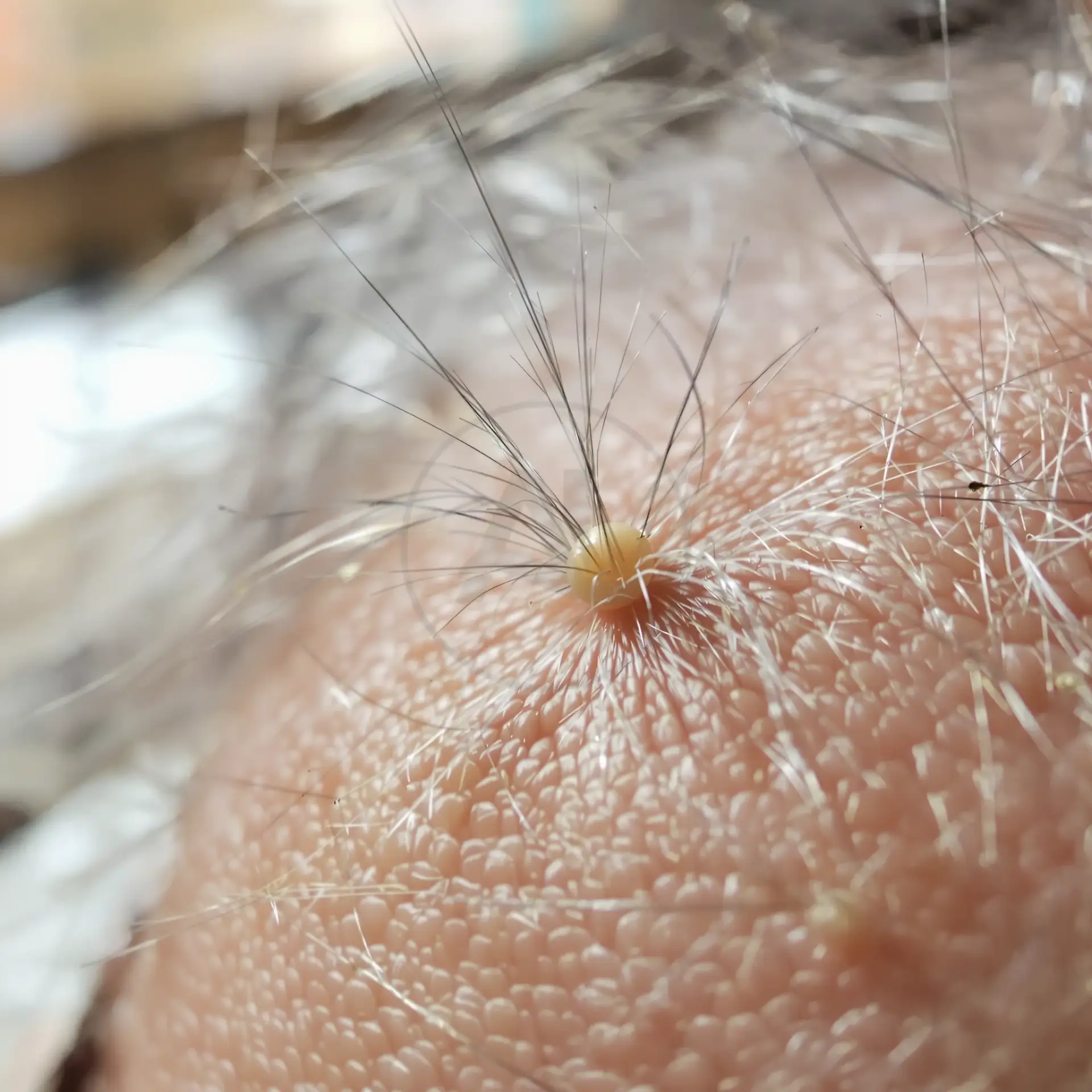 Dettaglio di un follicolo pilifero con il bulbo visibile sul cuoio capelluto