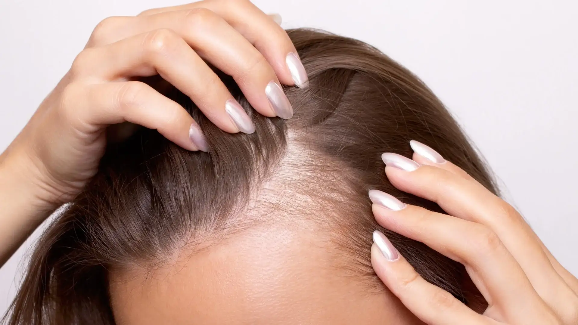 Cuoio capelluto scostato che mostra la radice dei capelli e la zona dove si trova il bulbo pilifero