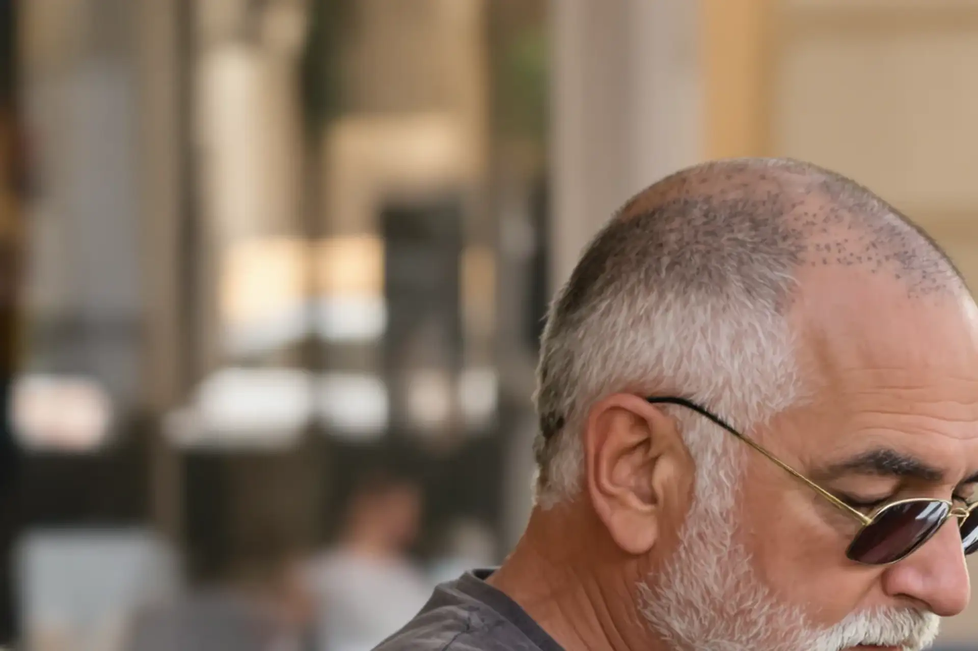 Scalp micropigmentation costs and results.