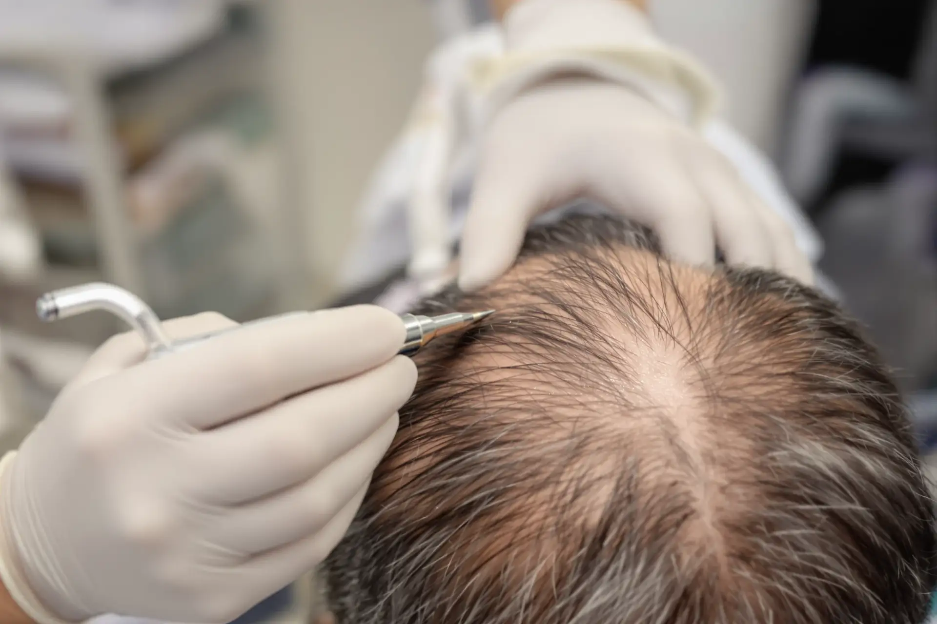Enhanced DHI Hair Transplant in Albania