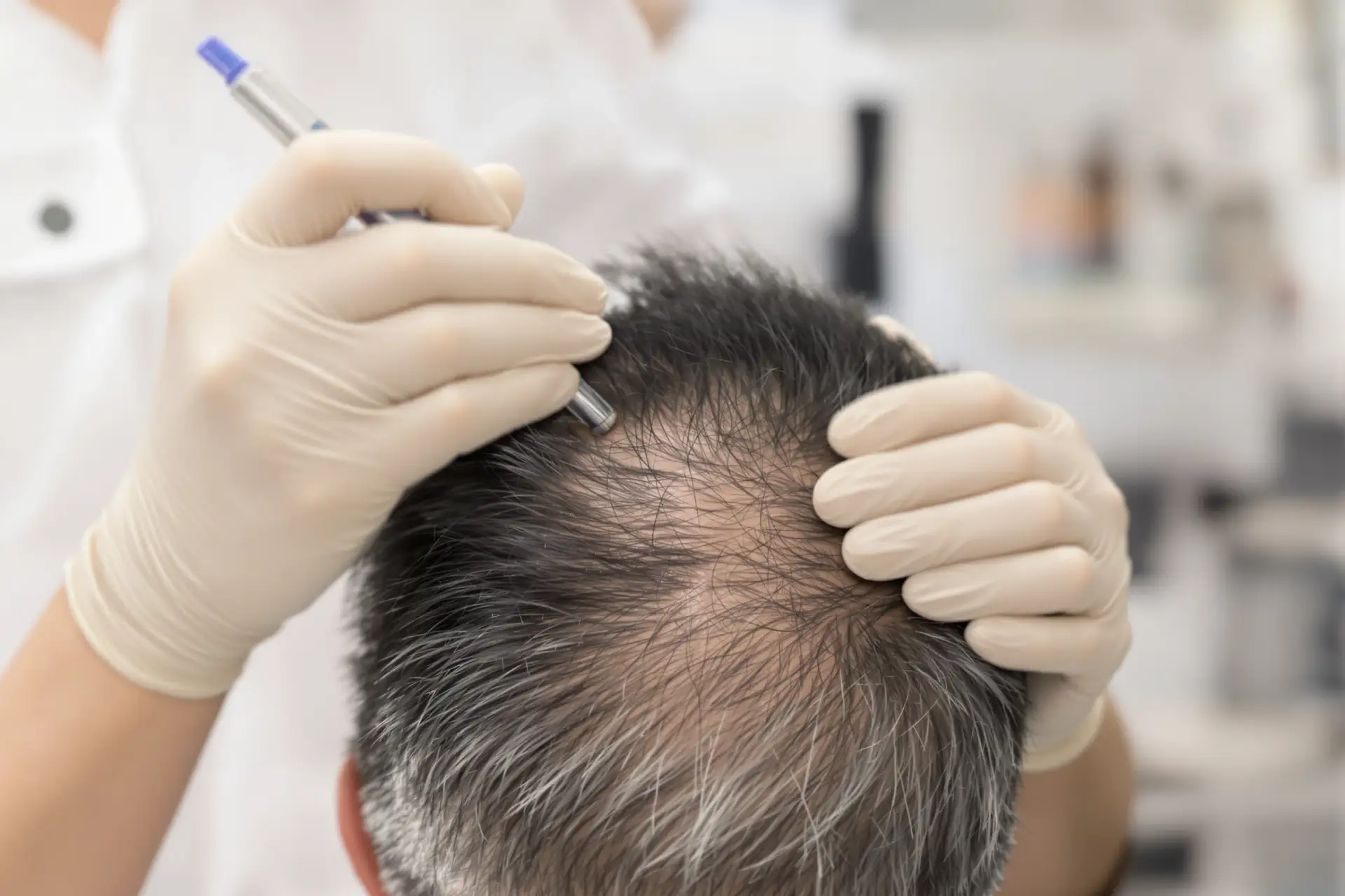 Trapianto di Capelli FUE Spiegato: Le Basi