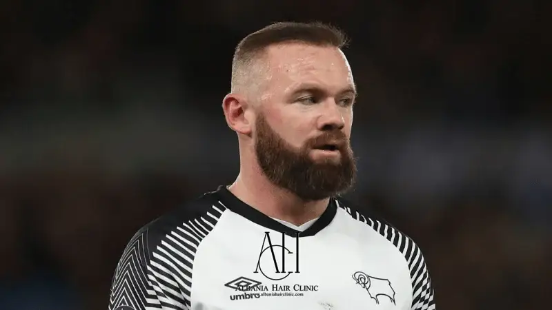 Transplanti i flokëve i Wayne Rooney