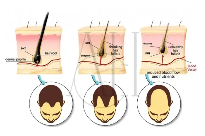 La perdita di capelli DHT (diidrotestosterone) provoca