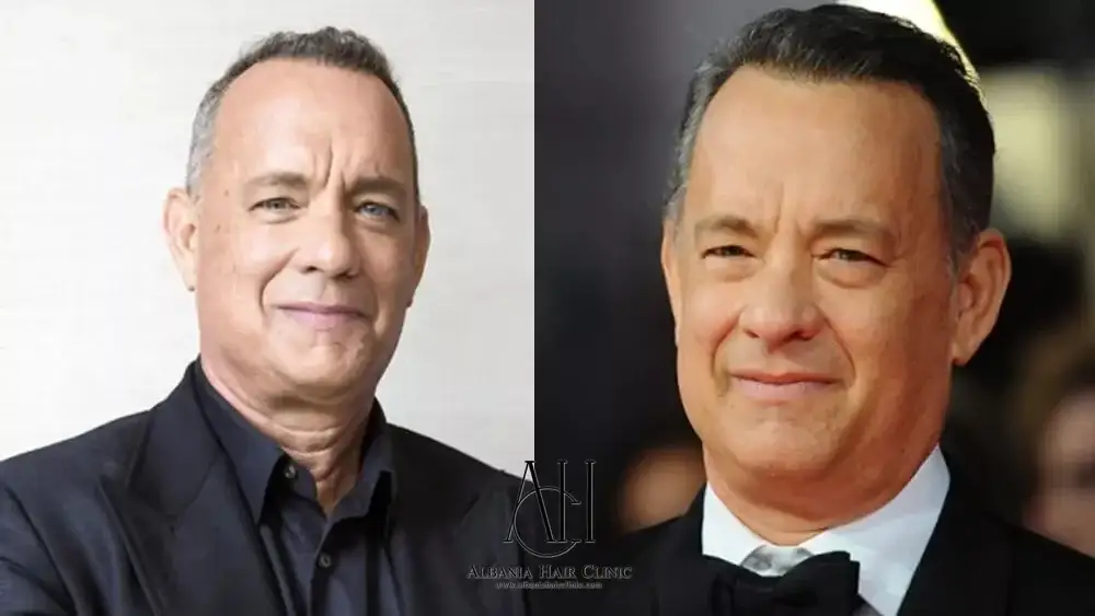 A ka bërë Tom Hanks transplant flokësh? Çfarë dihet në të vërtetë