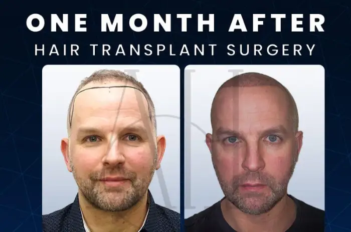Calum Best dhe gjashtë transplantet e flokëve: çfarë ka thënë vetë