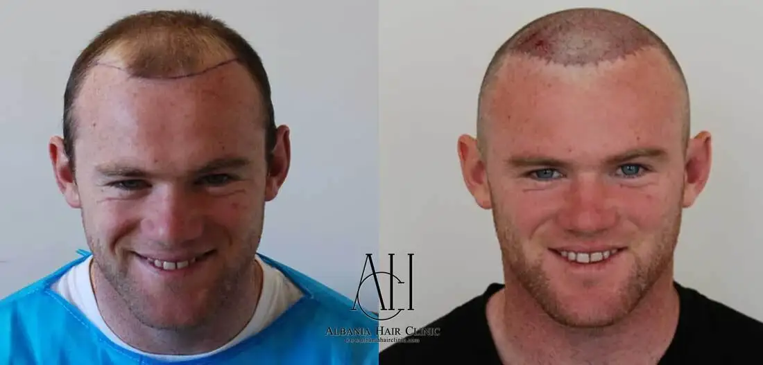 Wayne Rooney dhe transplanti i flokëve: çfarë ka thënë vetë