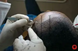Hair Transplant in Albania: Discover Top Procedures in Tirana