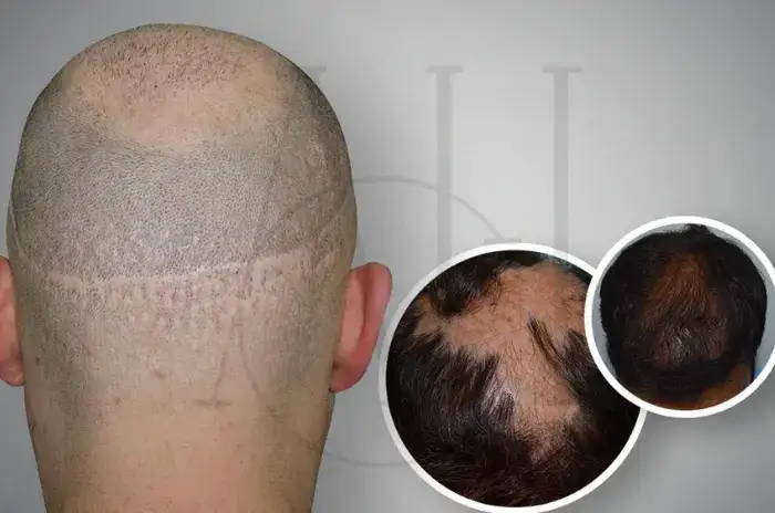 Simptomat e alopecisë cikatrizuese